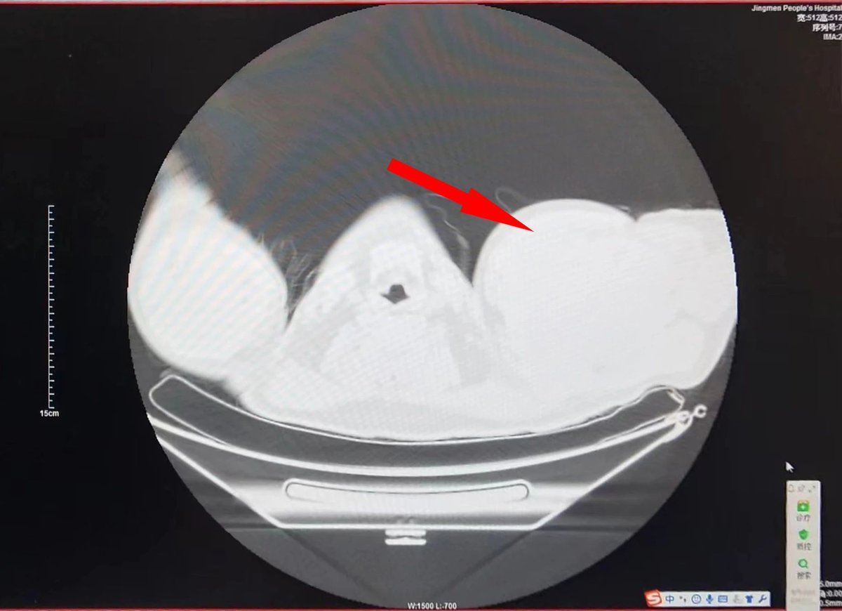 王先生左肩长出的“拳头”大小包块（CT影像）.jpg