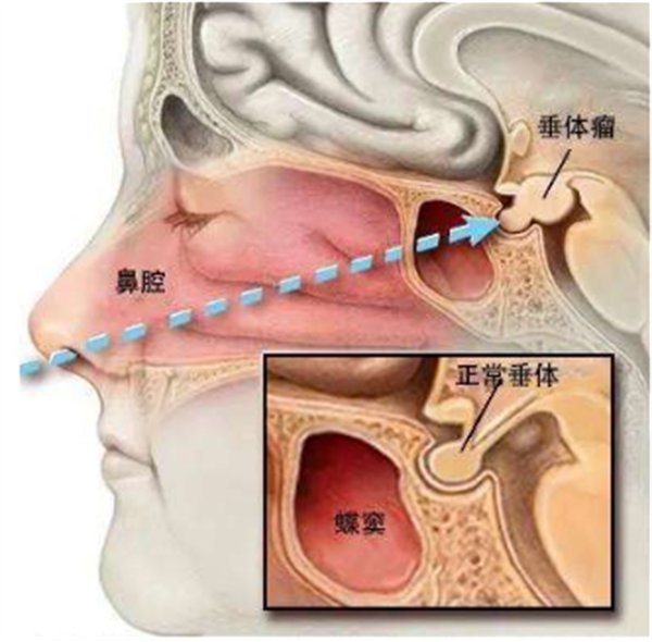 不开颅，鼻孔里面“夹出”肿瘤1857.png