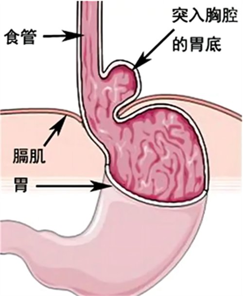 微创除“疝”，让“串门”的胃“回家”2068.png