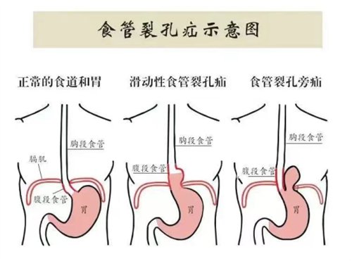 微创除“疝”，让“串门”的胃“回家”2080.png