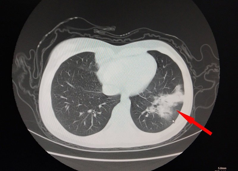 CT显示语嫣肺部有大片白色阴影.jpg