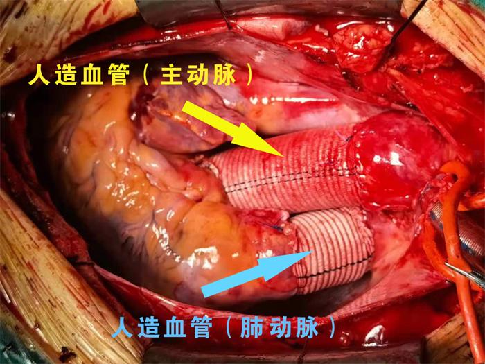 人造血管成功置换、吻合.png