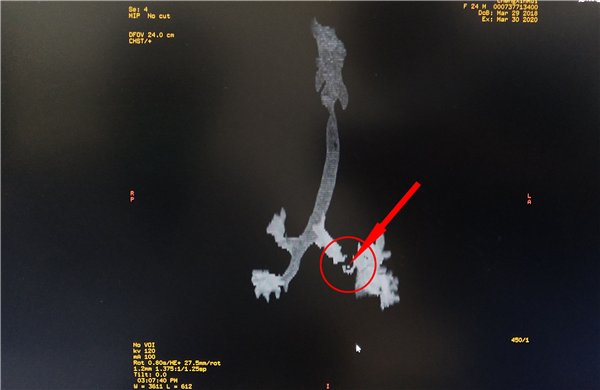 红圈内箭头处为位于左支气管的花生仁.png