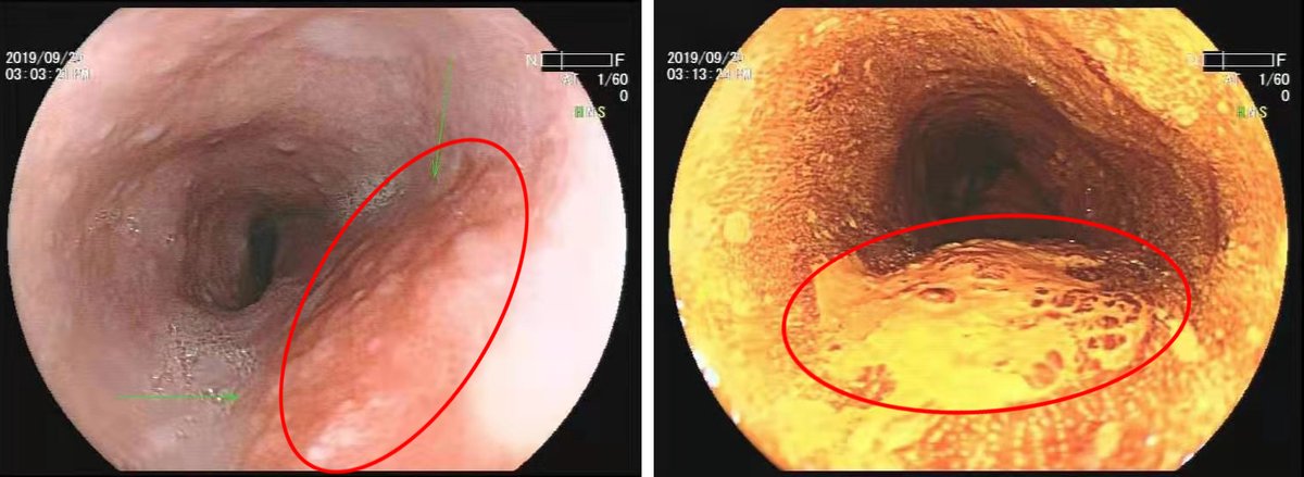 红圈处为无痛电子胃镜下的食管病灶.png