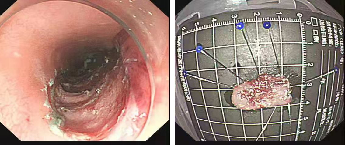消化内镜下剥离后的食管壁及病变黏膜.png
